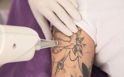 Experten warnen: Die Entfernung von Tattoos durch Laser ist nicht ungefährlich