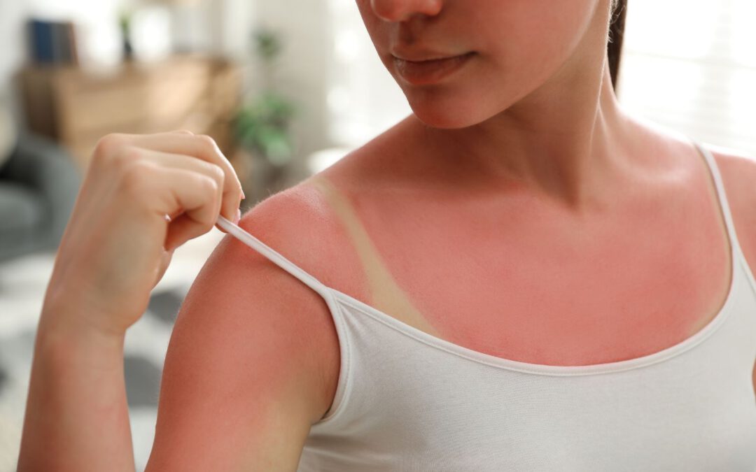 Sonnenbrand vorbeugen – wie man den UV-Strahlen entgeht
