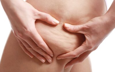 Cellulite – wie lässt sie sich behandeln?